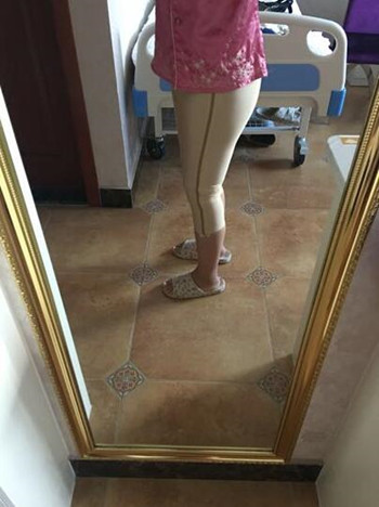 我的大腿吸脂真实果恢复对比案例图