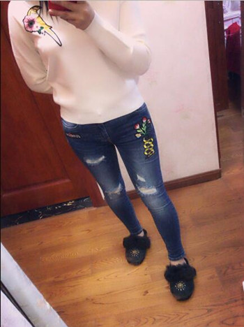 我的大腿吸脂真实果恢复对比案例图