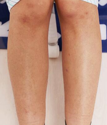 激光脱毛前腿部汗毛图