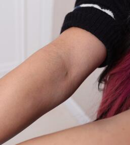 激光脱毛前手臂汗毛图