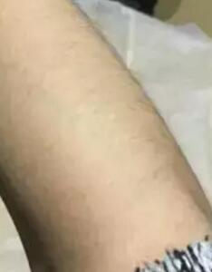 激光脱毛之前的照片