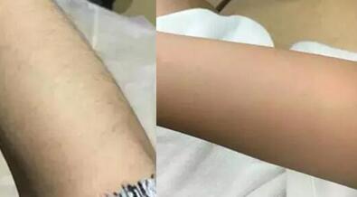第(一)次激光脱毛缓解后的前后对比图