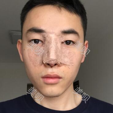 隆鼻整形恢复过程图分享，恢复得还不错吧