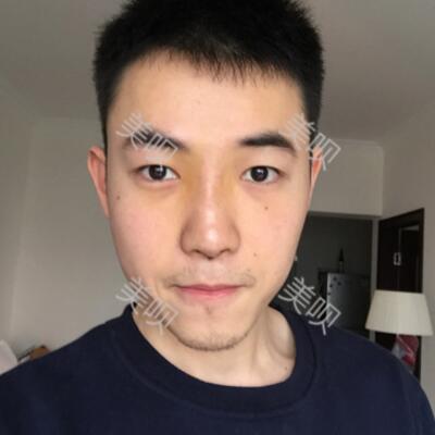 隆鼻整形恢复过程图分享，恢复得还不错吧
