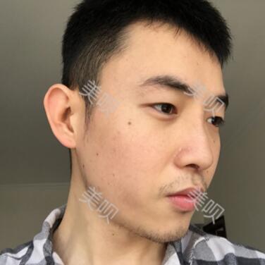 隆鼻整形恢复过程图分享，恢复得还不错吧
