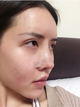 自体软骨隆鼻+自体脂肪丰苹果肌，成功逆袭成女神