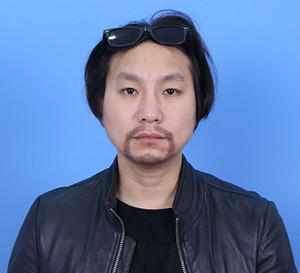 种植胡须手术前后过程以及对比照片分享