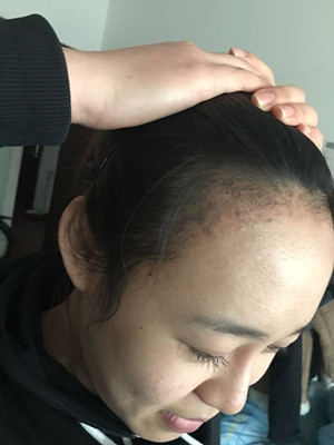 做了发际线种植手术，感觉还不错!