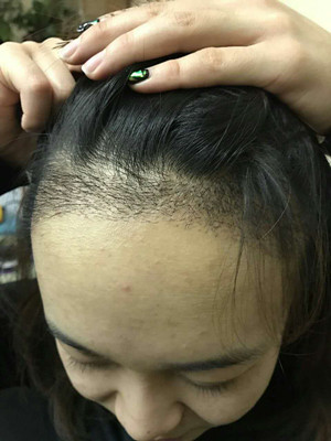 做了发际线种植手术，感觉还不错!