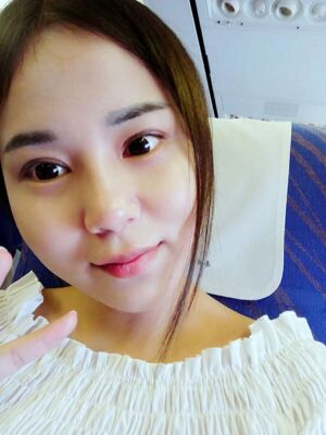 修复双眼皮过程 郑州美眼田院长做的