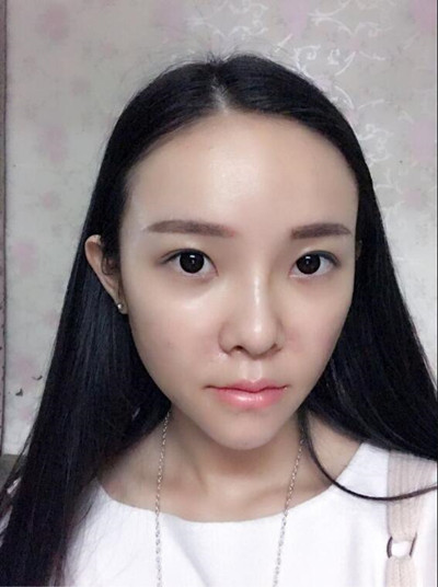 我的自体脂肪填充下巴+苹果肌的恢复过程 自体脂肪真的是一个好东西