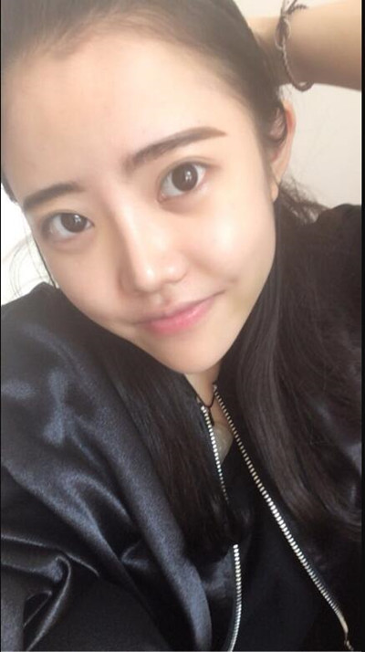 我的隆鼻整形恢复前后对果图 一个字帅