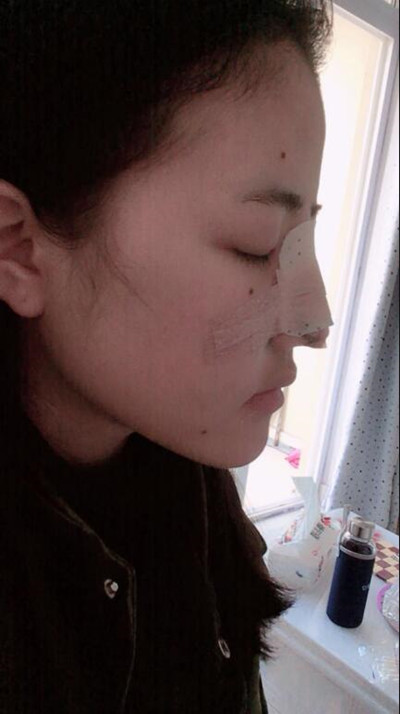 我的隆鼻整形恢复前后对果图 一个字帅