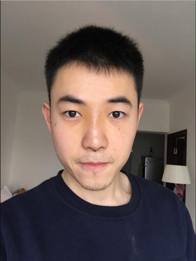 我的隆鼻整形案例恢复过程 大老爷们也有一个爱没的心