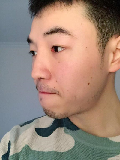 我的隆鼻整形案例恢复过程 大老爷们也有一个爱没的心