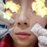 玻尿酸填充法令纹恢复过程分享，注射价格3000元