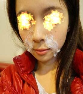 确定好玻尿酸品牌、注射部位注射计量后，就开始敷*药膏