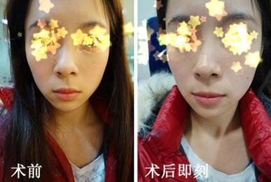 玻尿酸填充法令纹前后对比图