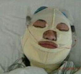 磨下颌角手术后第(一)天的照片