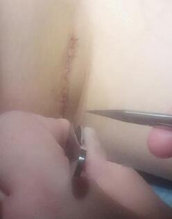 假体隆胸恢复一周，拆线了