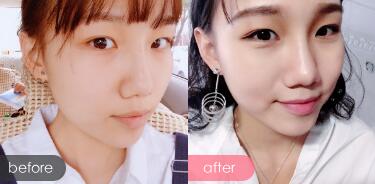 玻尿酸隆鼻前后对比图