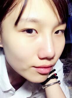 注射玻尿酸隆鼻第二天