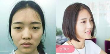 整形前后对比图，左边是微整形前