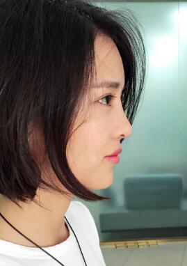 割双眼皮+开眼角+隆鼻整形