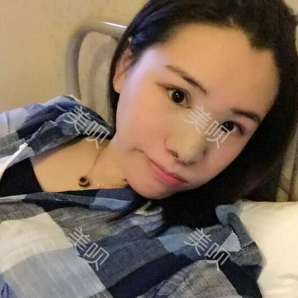 隆鼻整形改变了我的大蒜鼻附上我的手术恢复过程