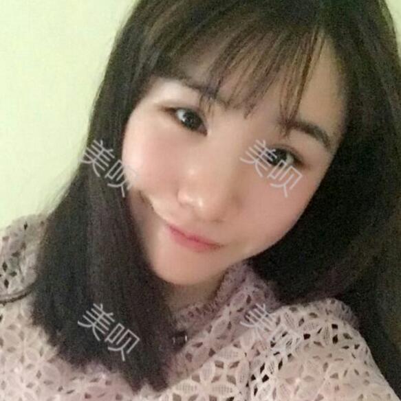 隆鼻整形改变了我的大蒜鼻附上我的手术恢复过程