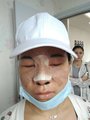 广州广美做的假体隆鼻，给大家分享一下手术前后过程以及对比照片