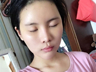 自体脂肪填充全脸，前后对比一下果棒棒哒!