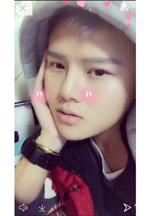 玻尿酸隆鼻+垫下巴亲身经历~~果不错哦