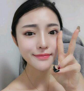 隆鼻整形1个月真实恢复期图片