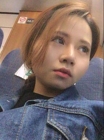 大鼻子就得做隆鼻整形手术改良 我的果就挺不错的