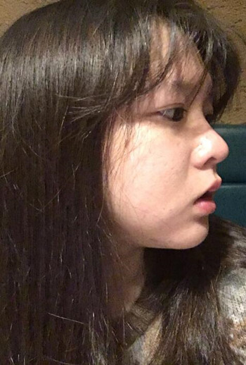 我的颊脂肪垫切除+假体垫下巴整形恢复果心情日记