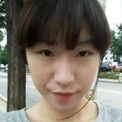 隆鼻整形+双眼皮手术两个月了，分享恢复前后对比果照片~