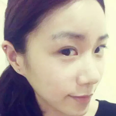 隆鼻整形+双眼皮手术两个月了，分享恢复前后对比果照片~