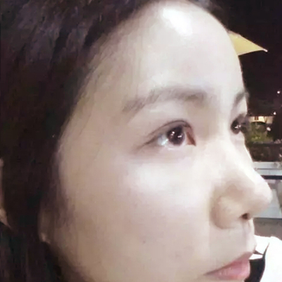 隆鼻整形+双眼皮手术两个月了，分享恢复前后对比果照片~
