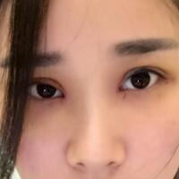 全切双眼皮价格6800元，无神小眼变光彩大双眼恢复过程分享