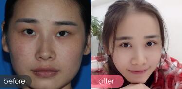 割双眼皮前后对比图