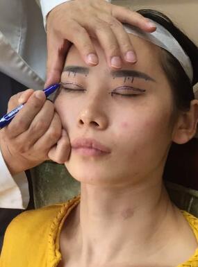 割双眼皮术前设计图