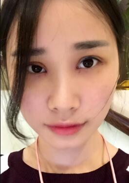 割双眼皮一周拆线