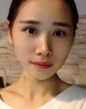 割双眼皮恢复照片