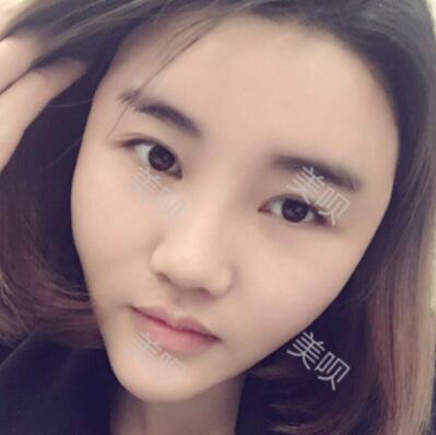 自体脂肪面部填充恢复日记分享，丰了额头和苹果肌
