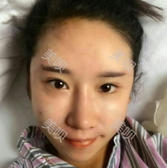 在西安爱丁做的自体脂肪面部填充真实整形恢复过程图