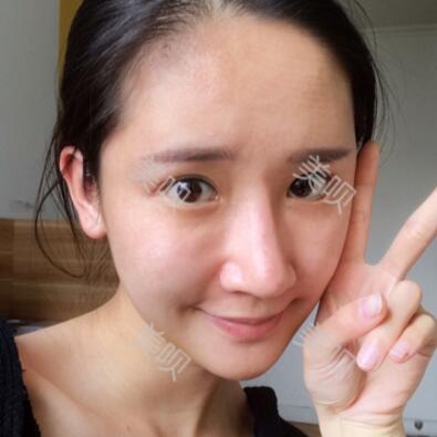 在西安爱丁做的自体脂肪面部填充真实整形恢复过程图