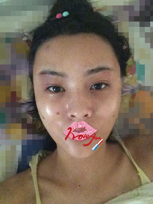 自体脂肪填充全脸，我也可以美美哒