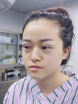 真人记录了8周全切双眼皮手术过程，还有对比照片哟