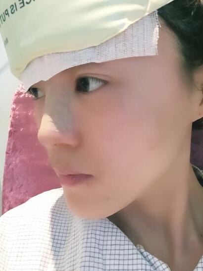 鼻子做完假体12天恢复图